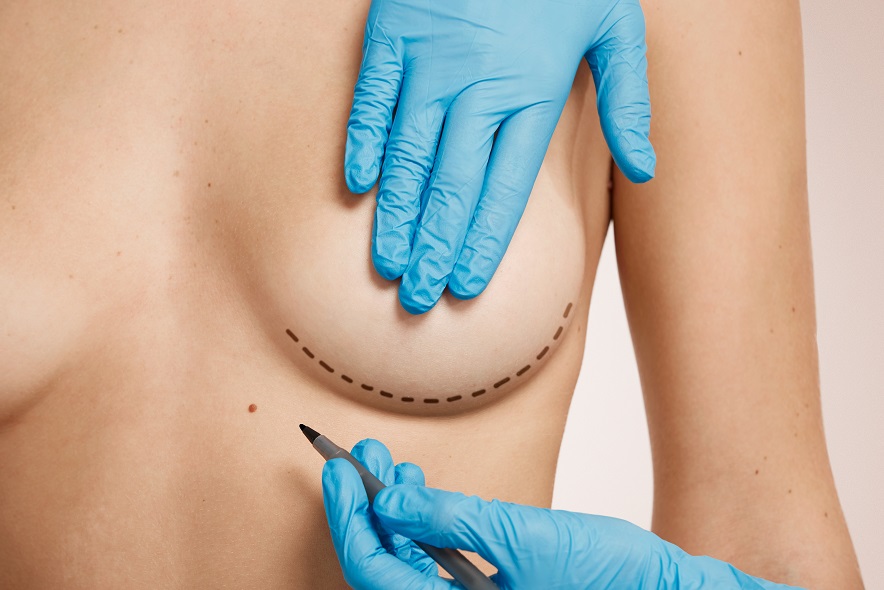 Chirurgie Mammaire - Dr Sabiani